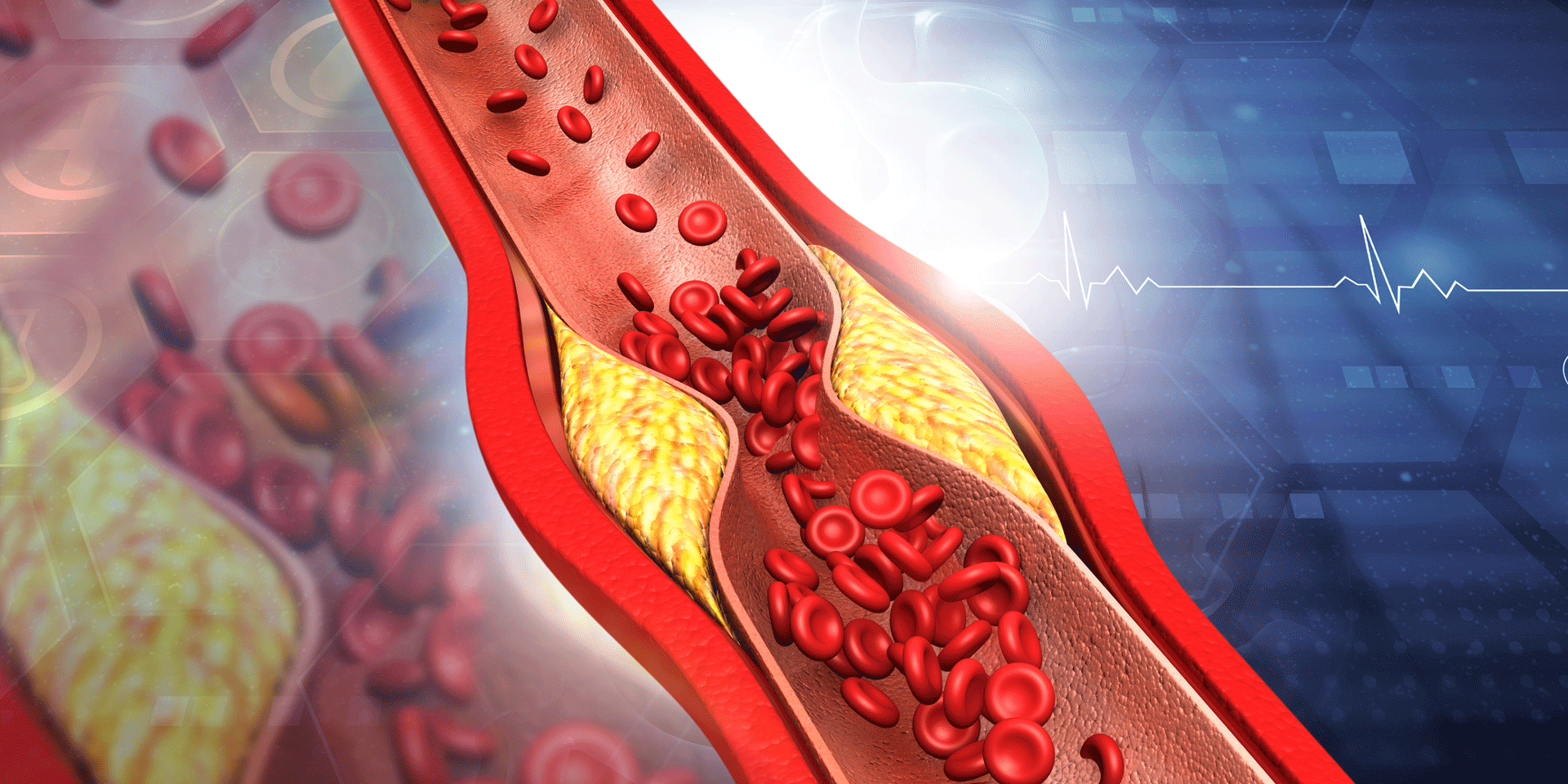 arteriosklerose der mensch ist so jung  seine gefässe